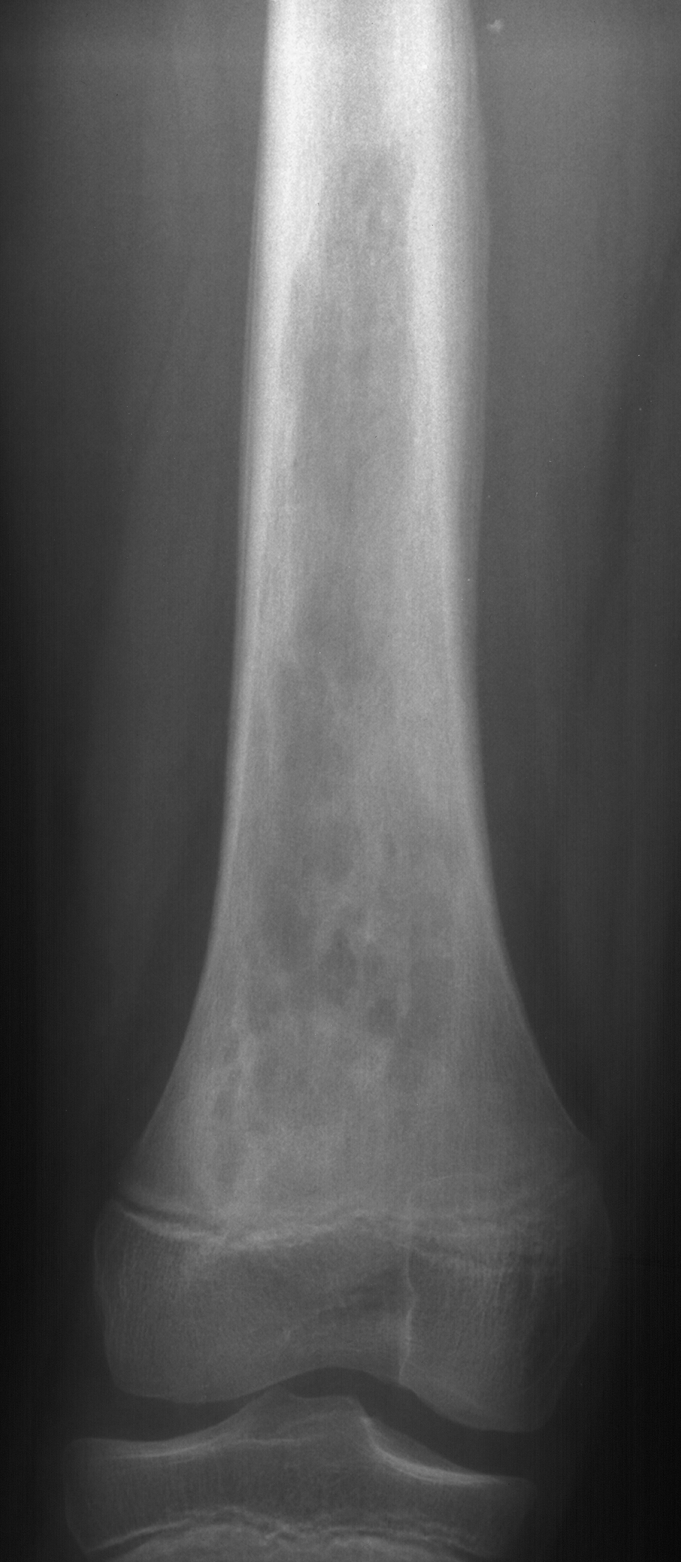 1. AP femur
