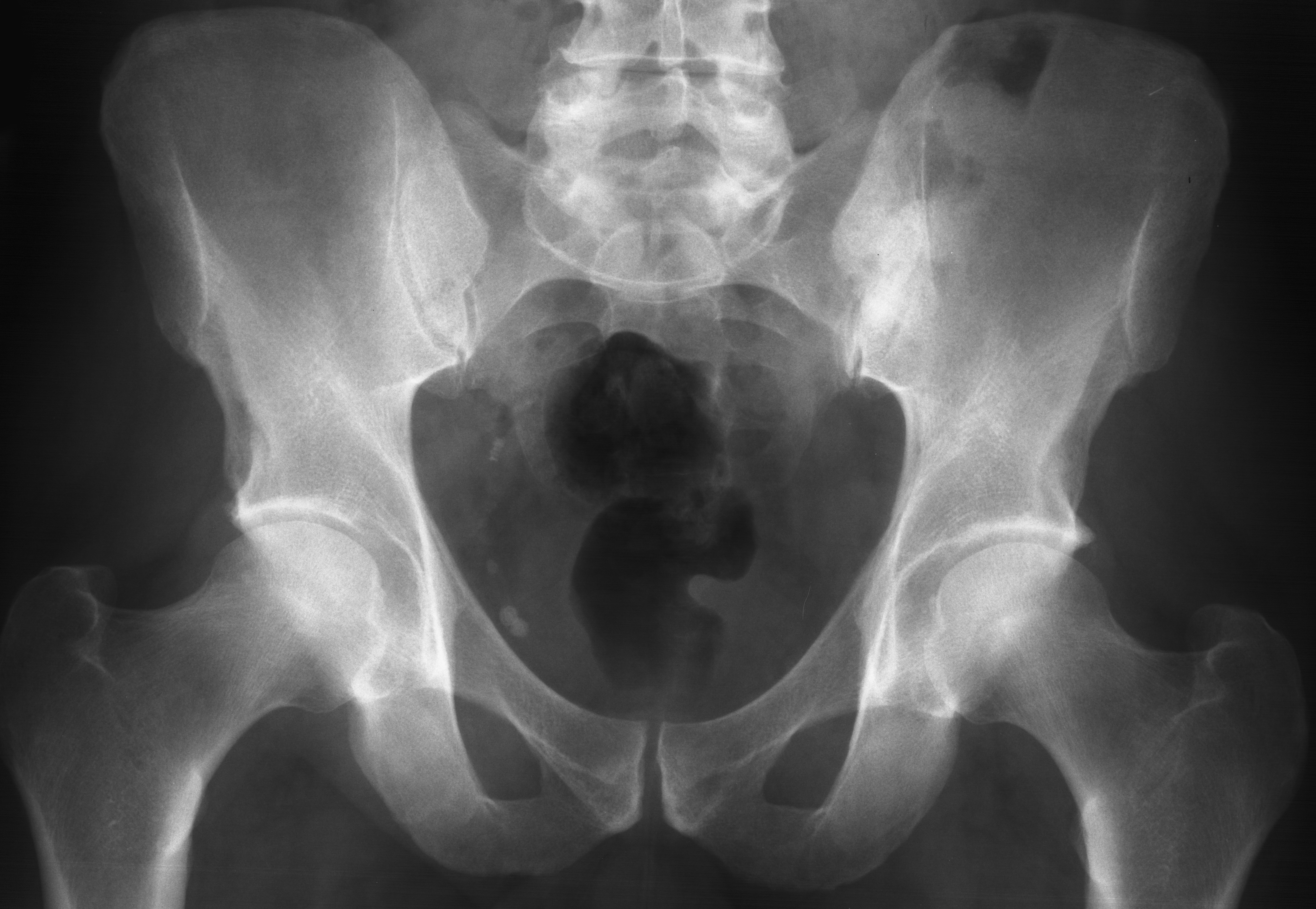 1. AP pelvis