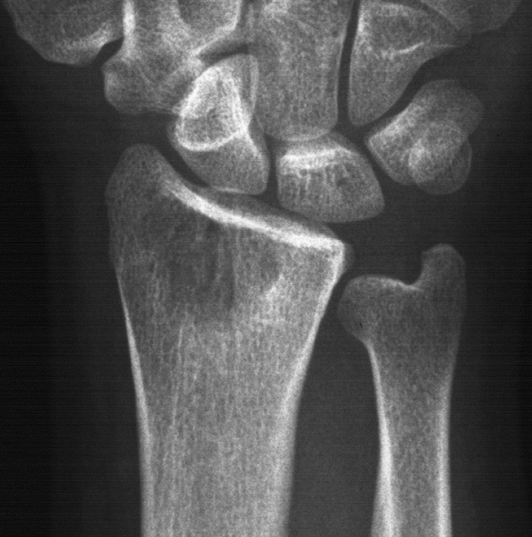 1. PA wrist