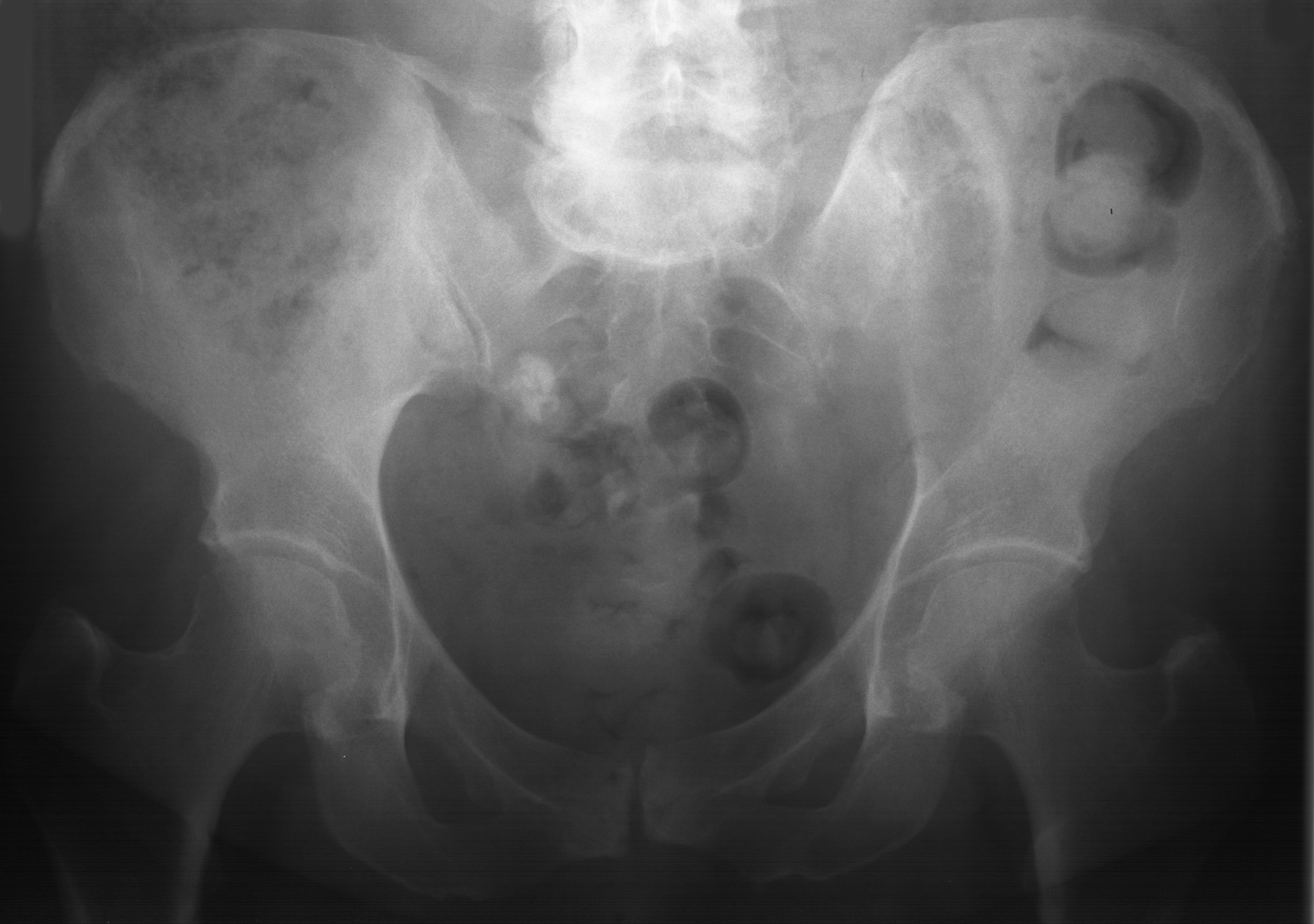 1. AP pelvis