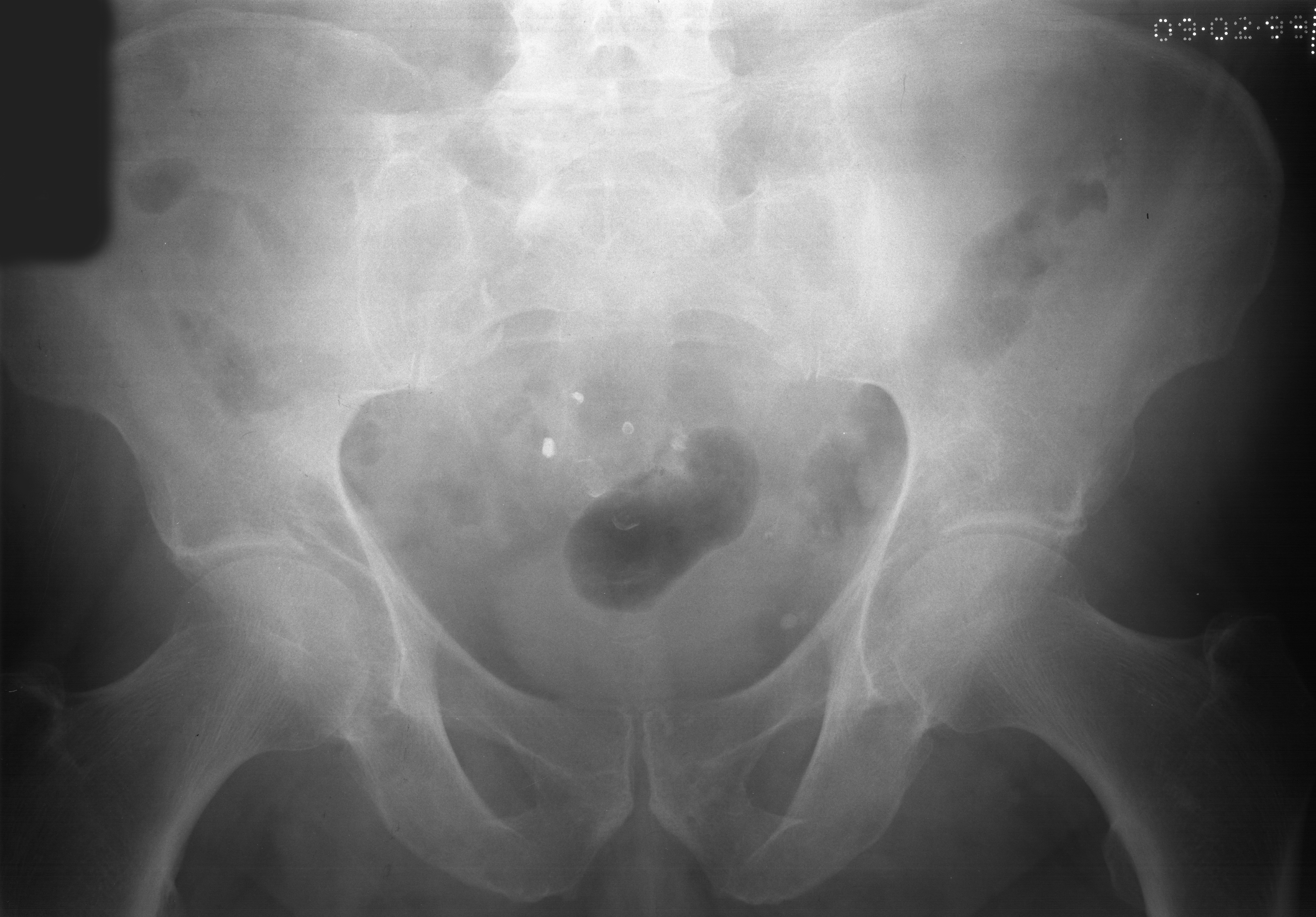 1. AP pelvis
