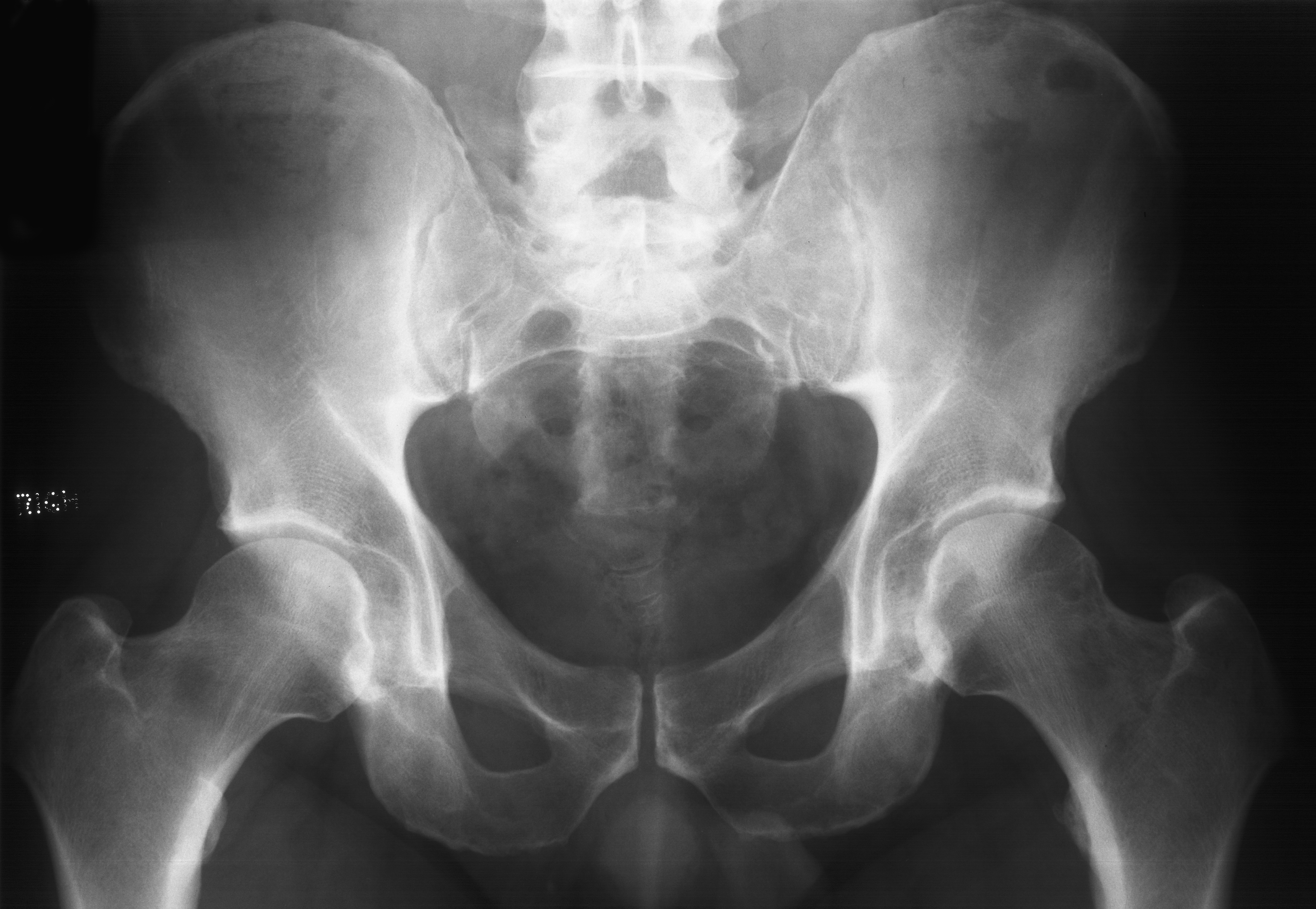 1. AP pelvis