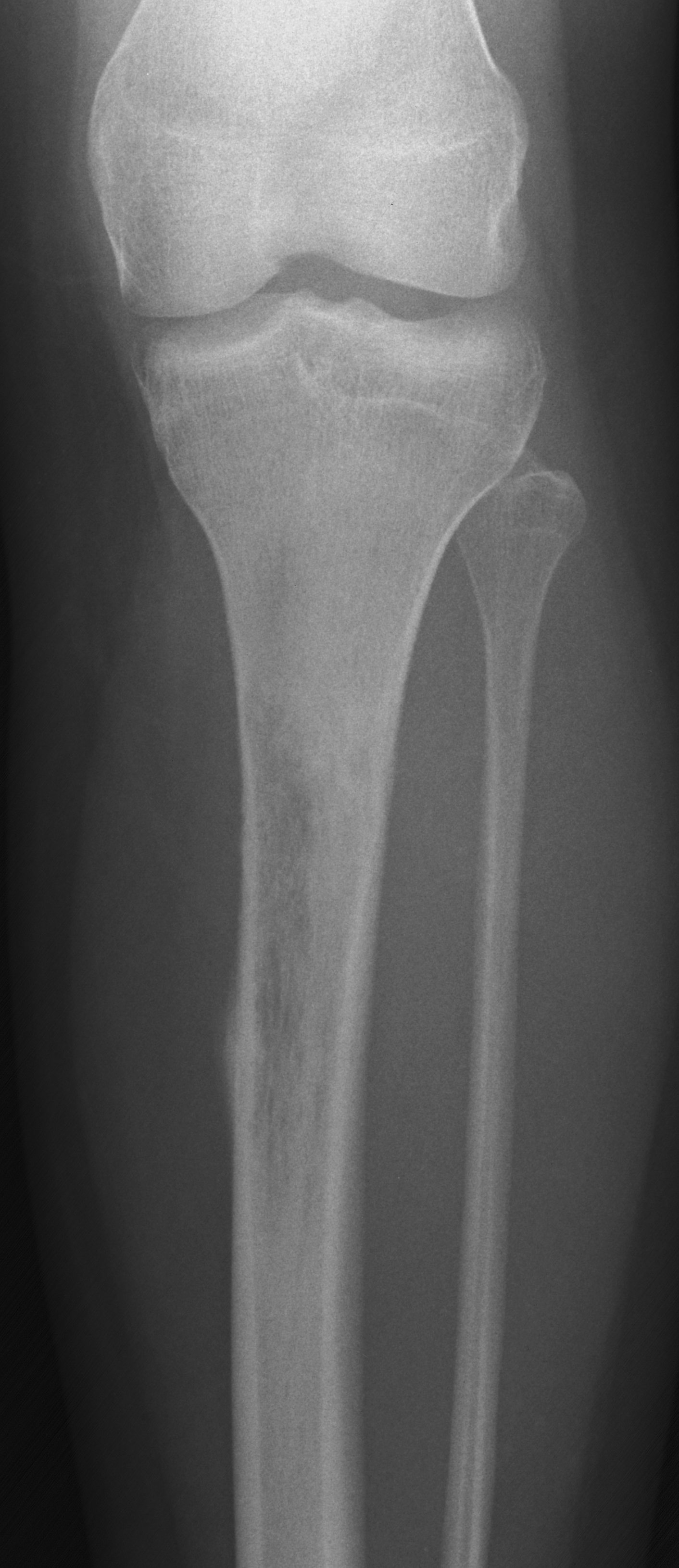 1. AP tibia
