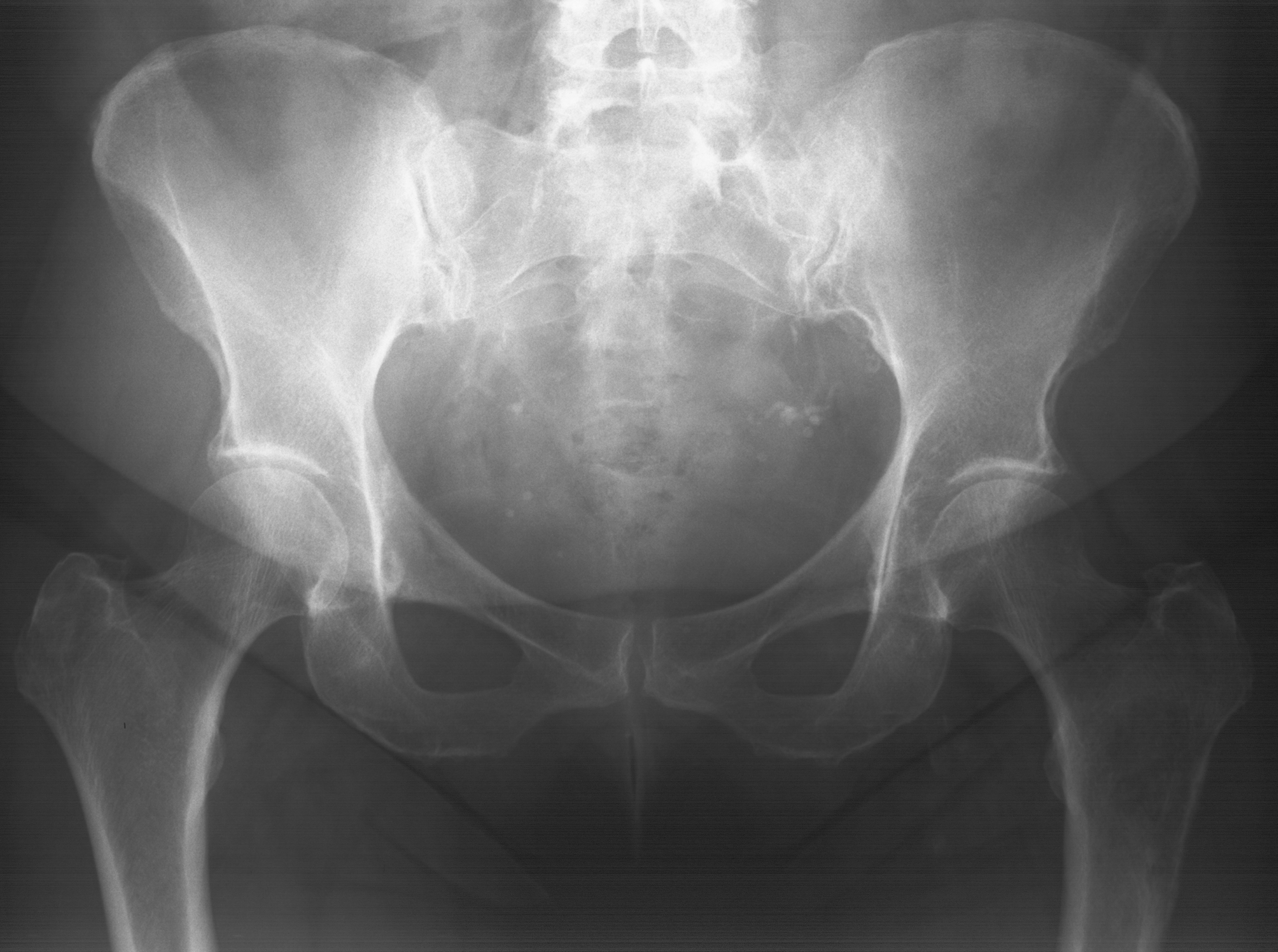 1. AP pelvis