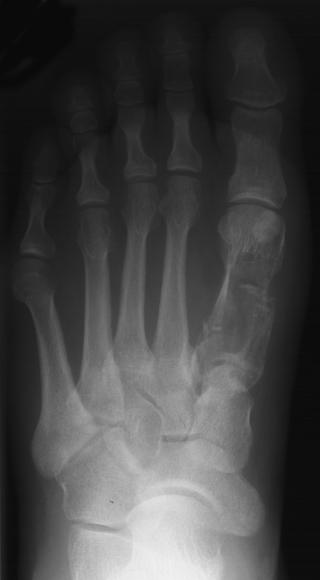 1. DP foot