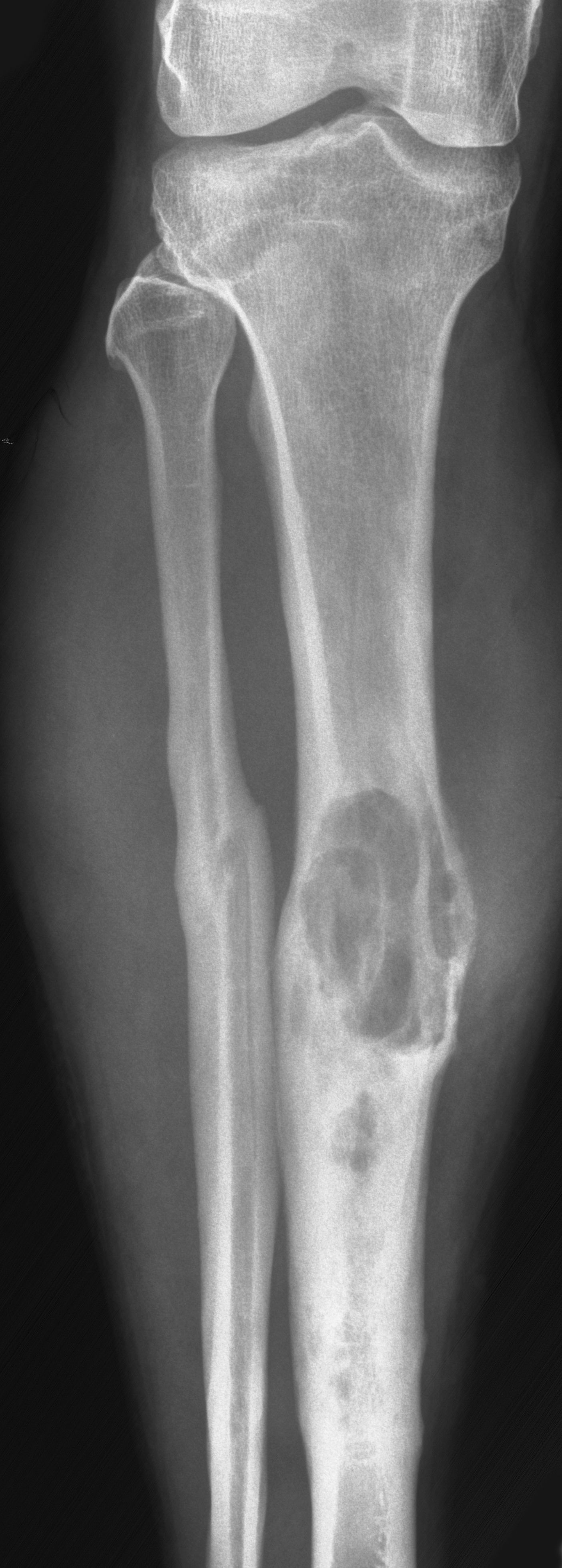 1. AP tibia