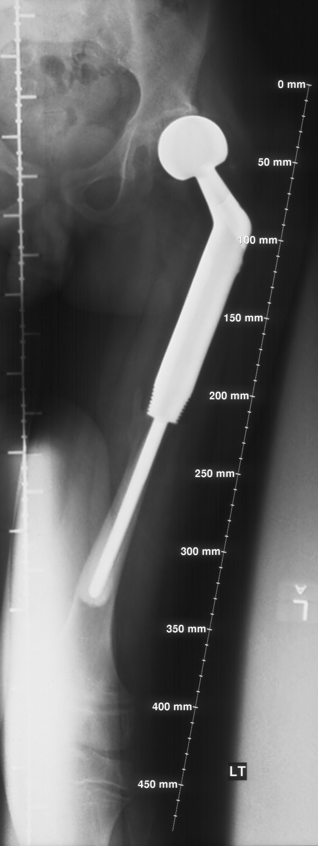 1. AP femur