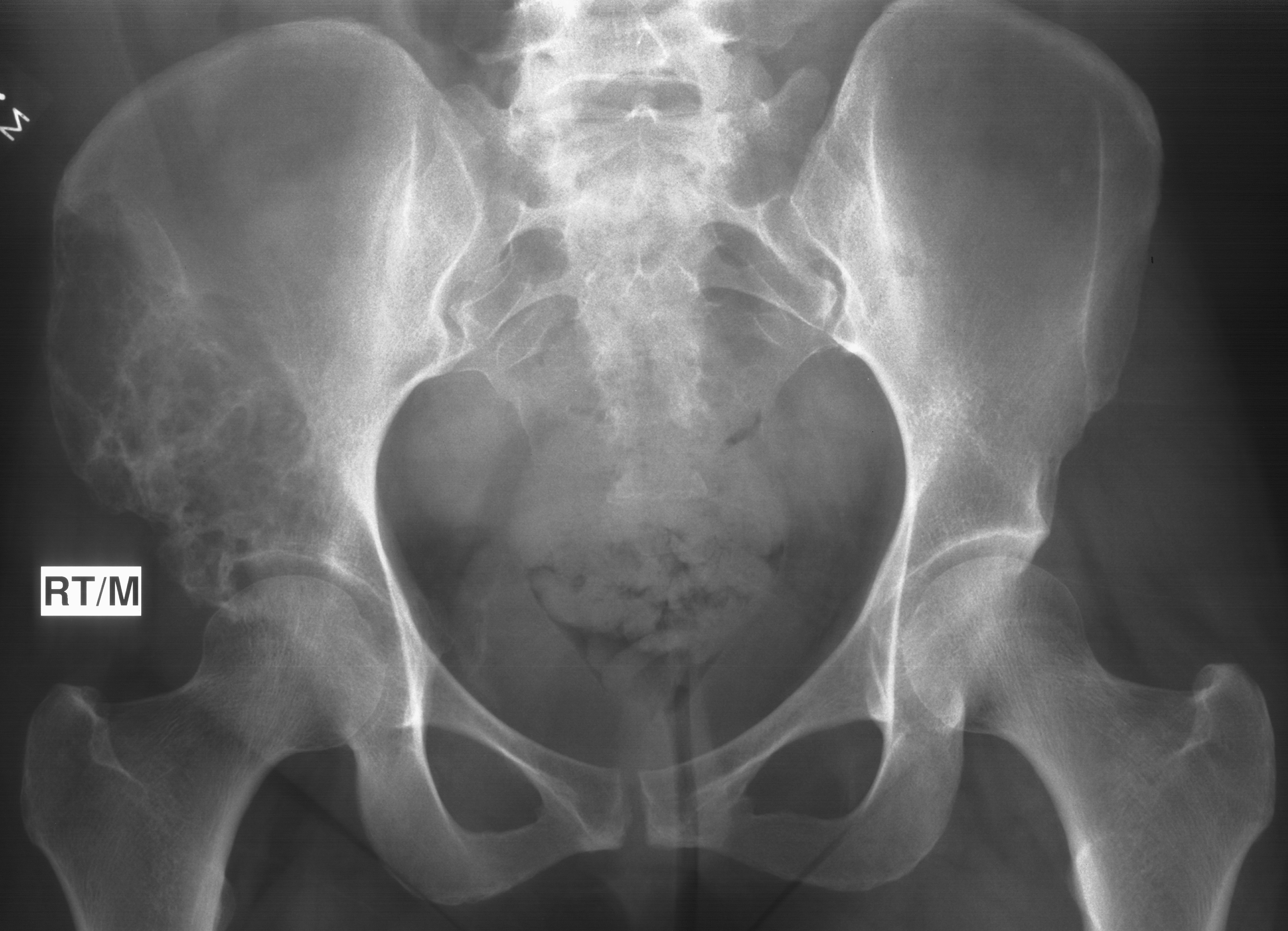 1. AP pelvis