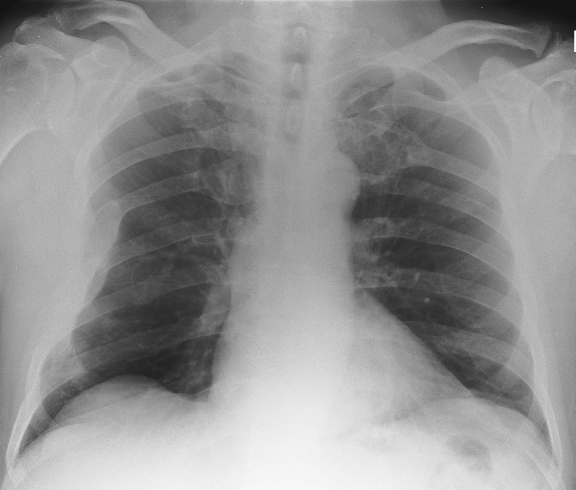 1. PA chest