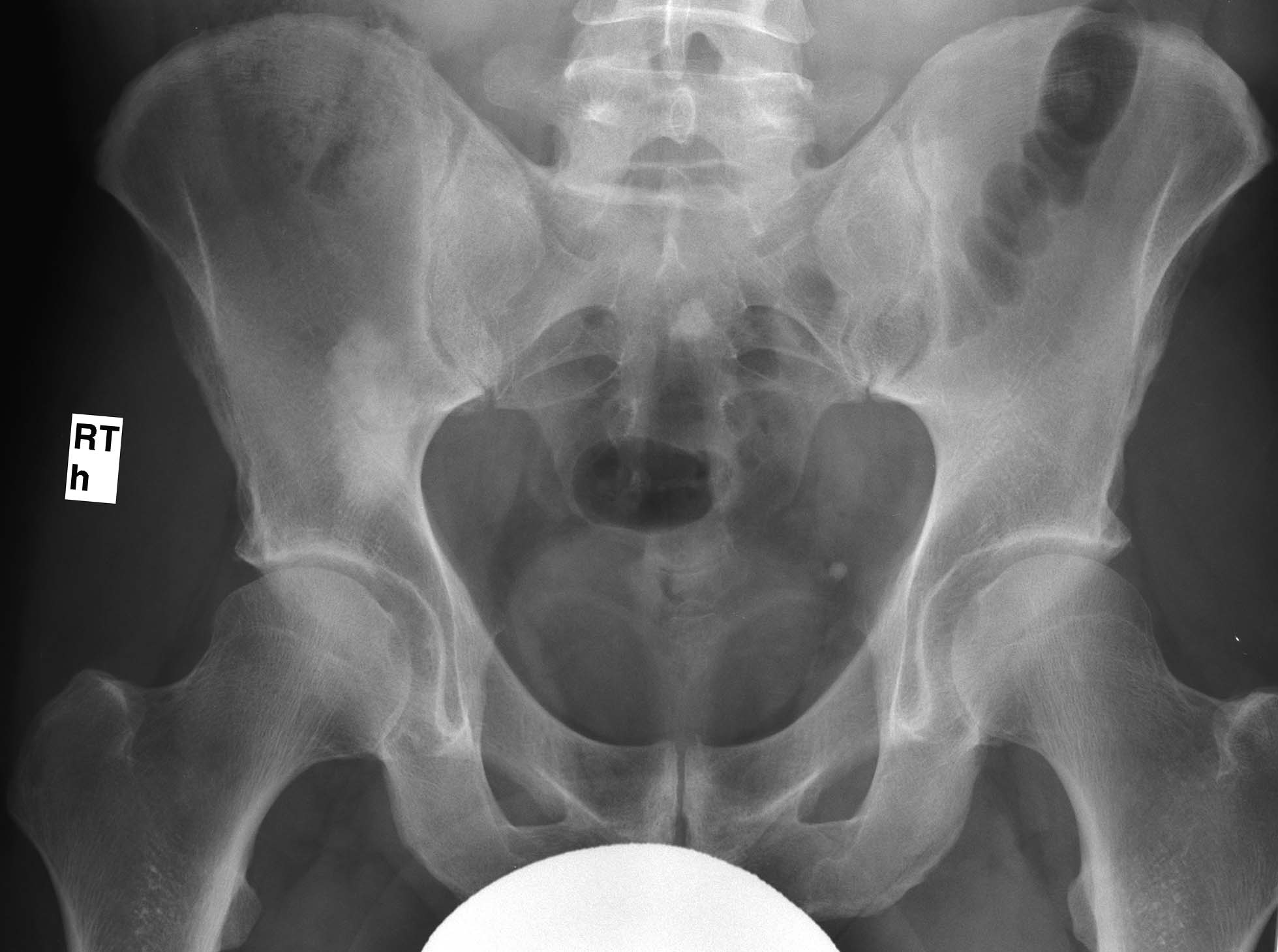 1. AP pelvis