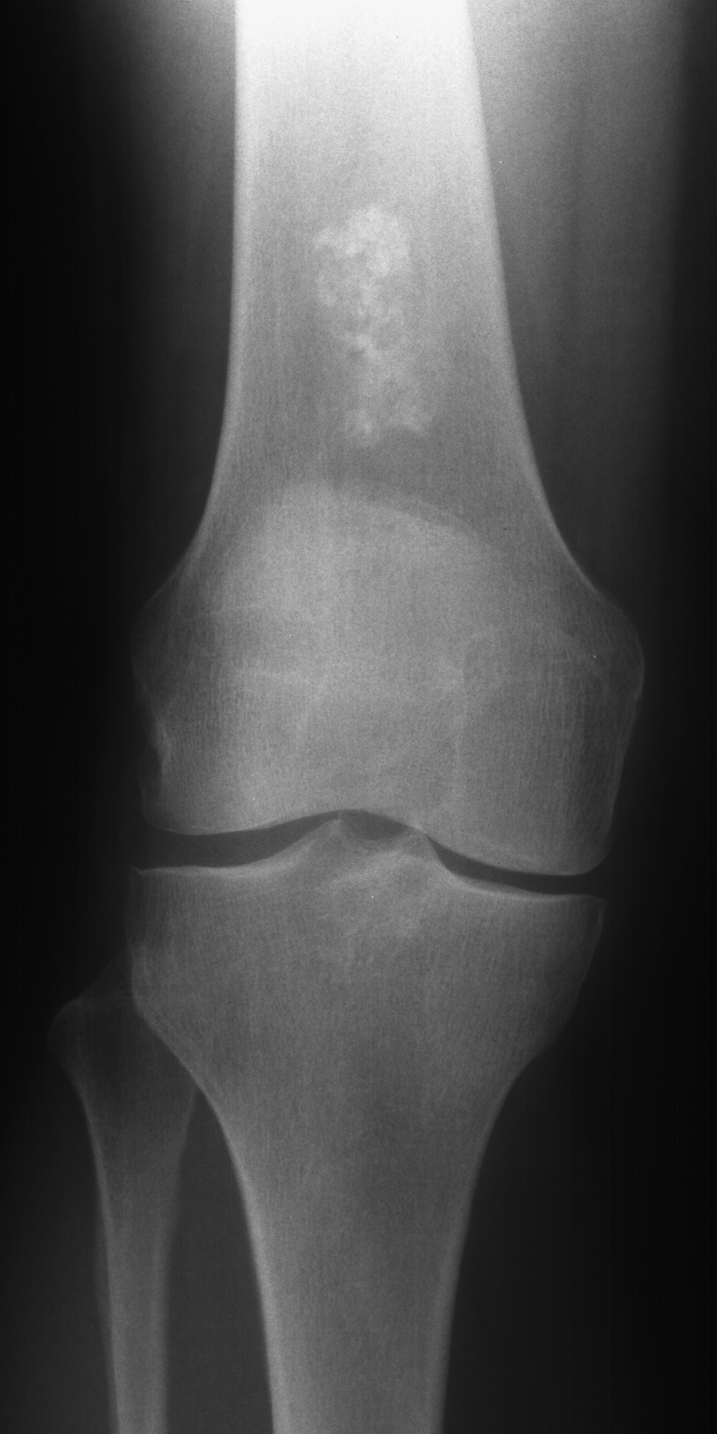 1. AP knee