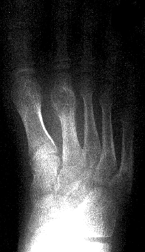 1. PA foot