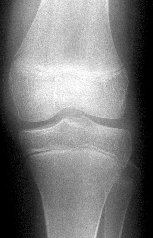 1. AP knee