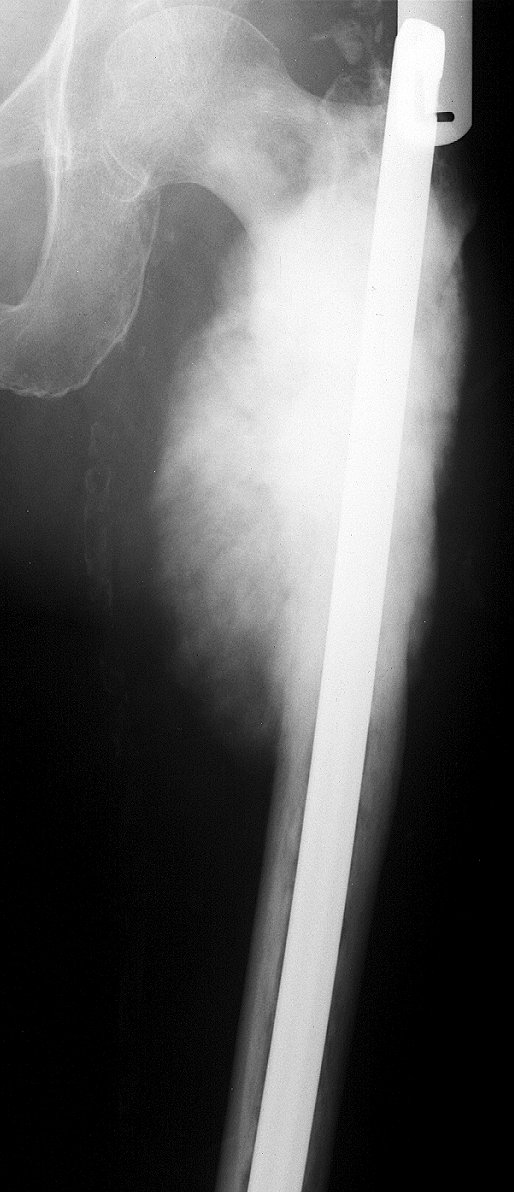 1. AP femur