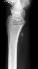 1. Lat wrist