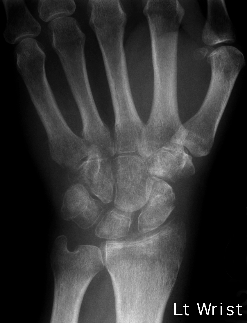 1. PA wrist