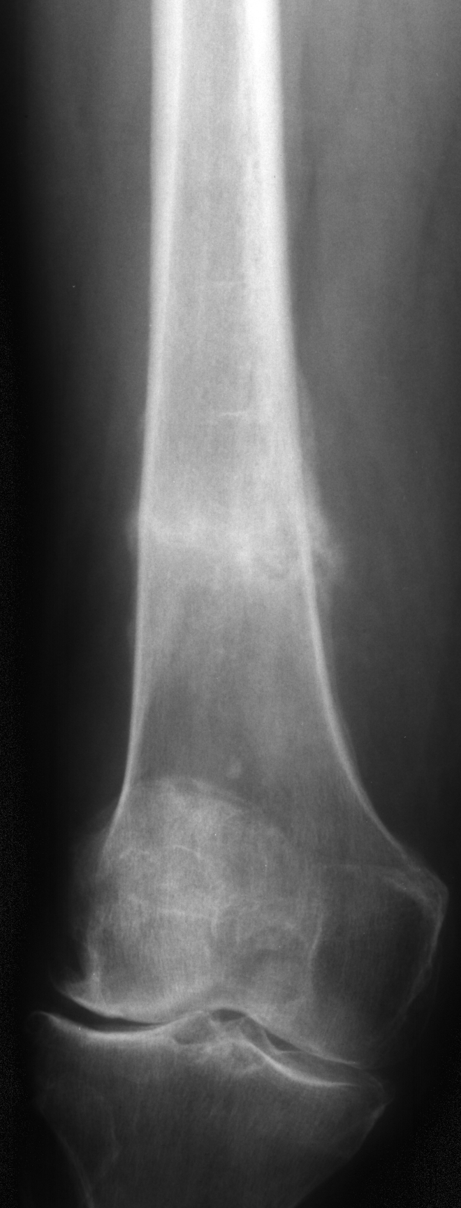 1. AP femur