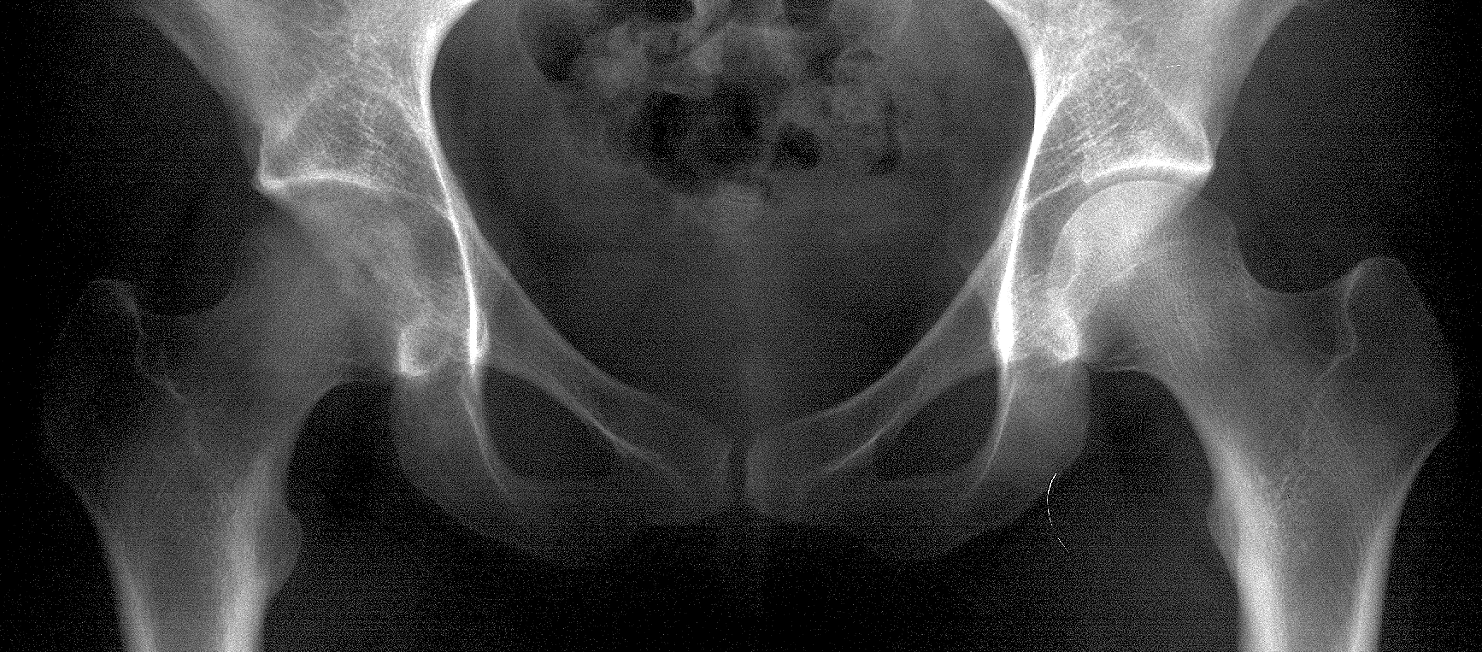 1. AP hips
