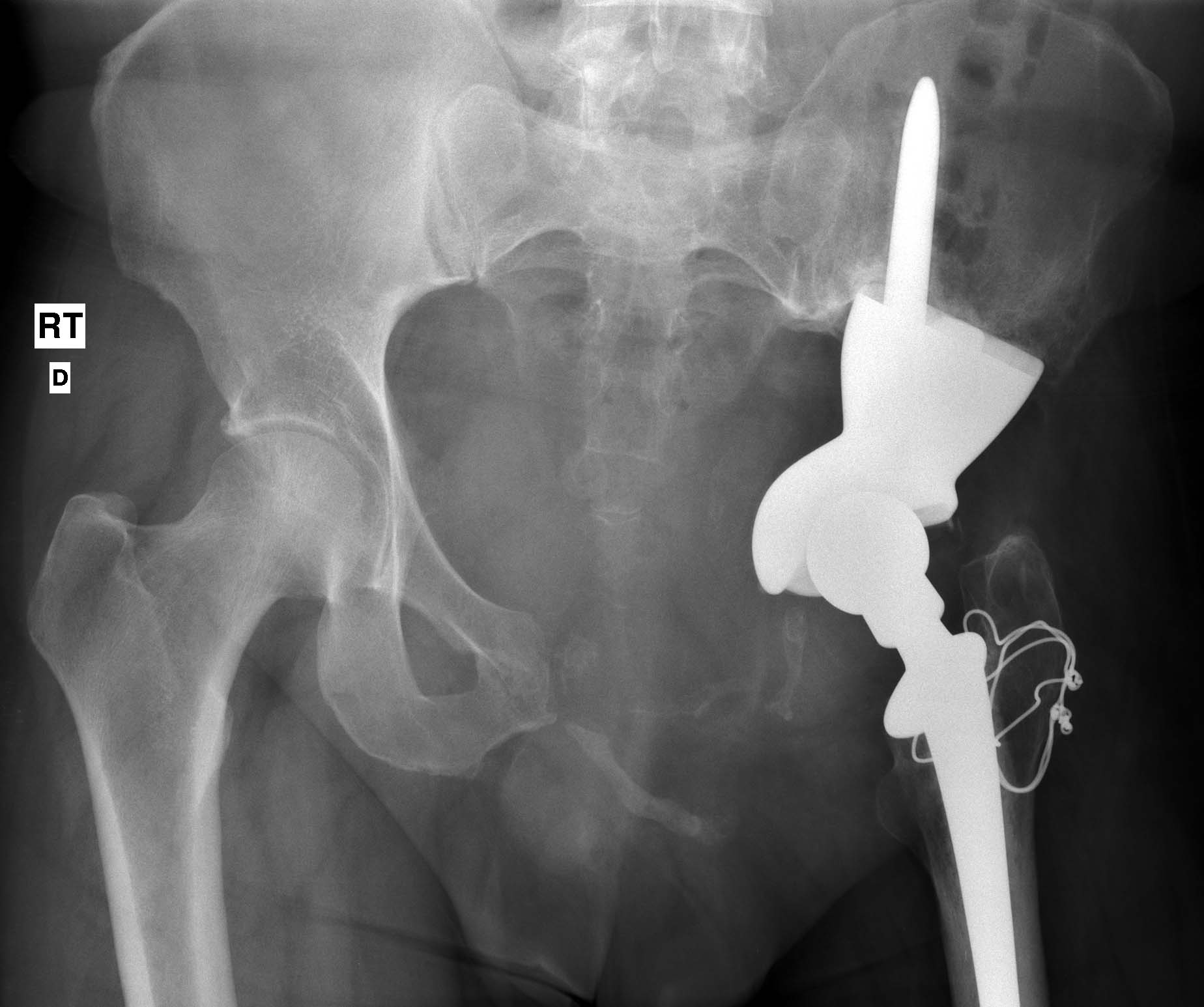 1. AP pelvis