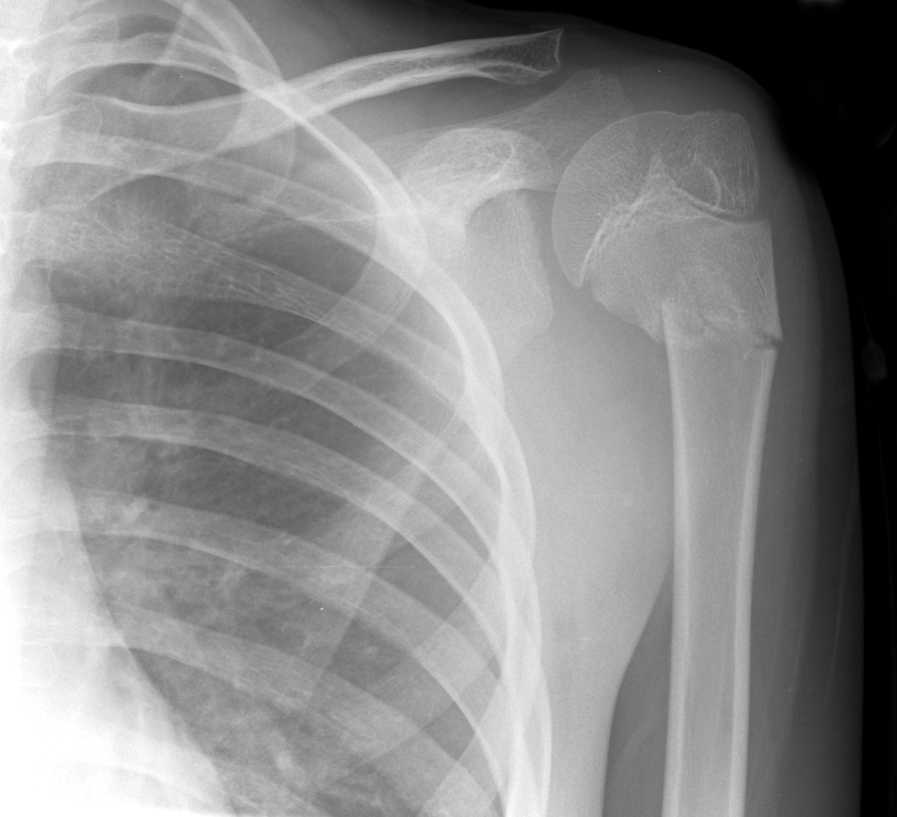 AP shoulder