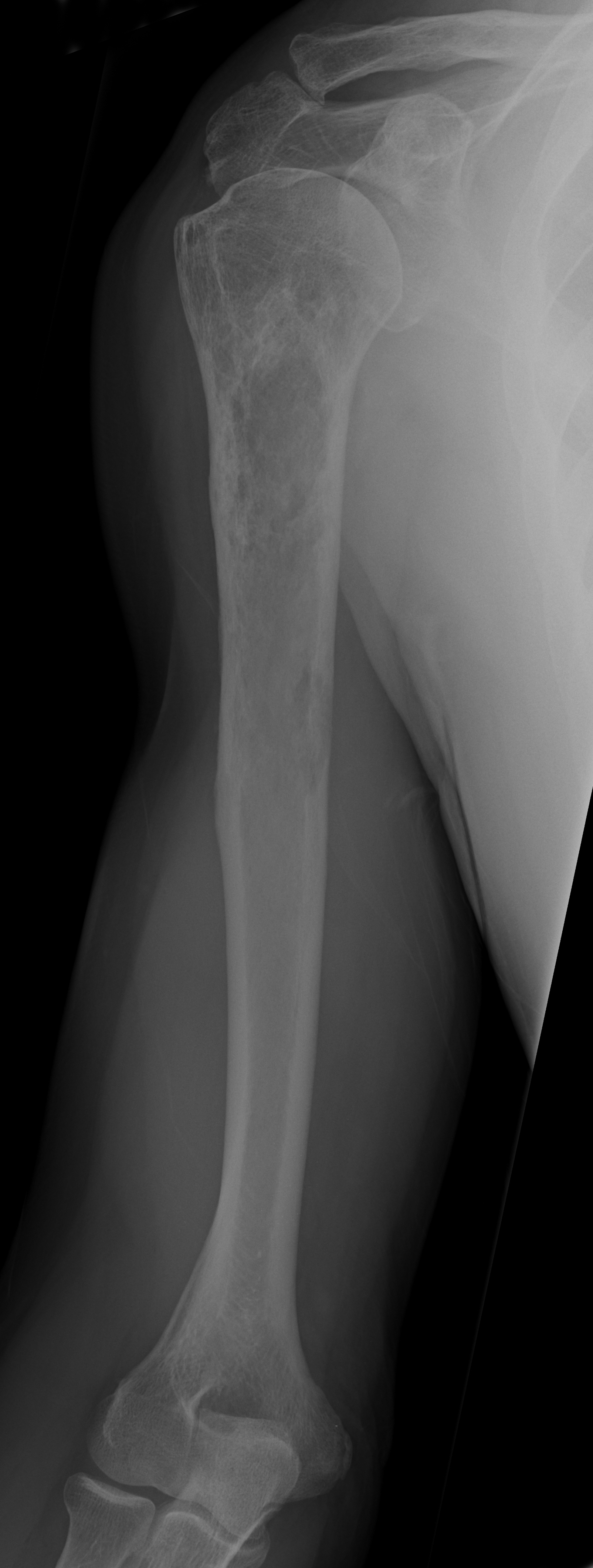| AP humerus