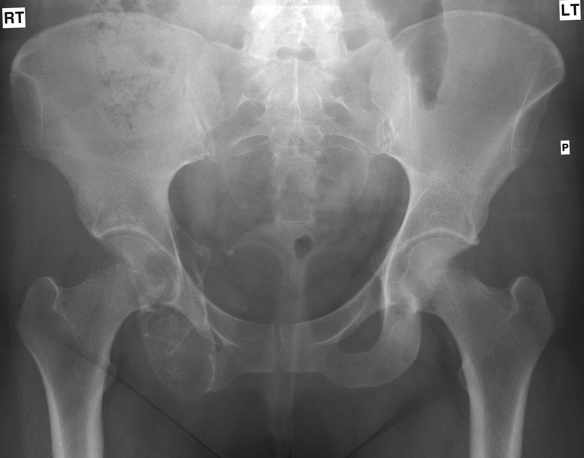 AP pelvis