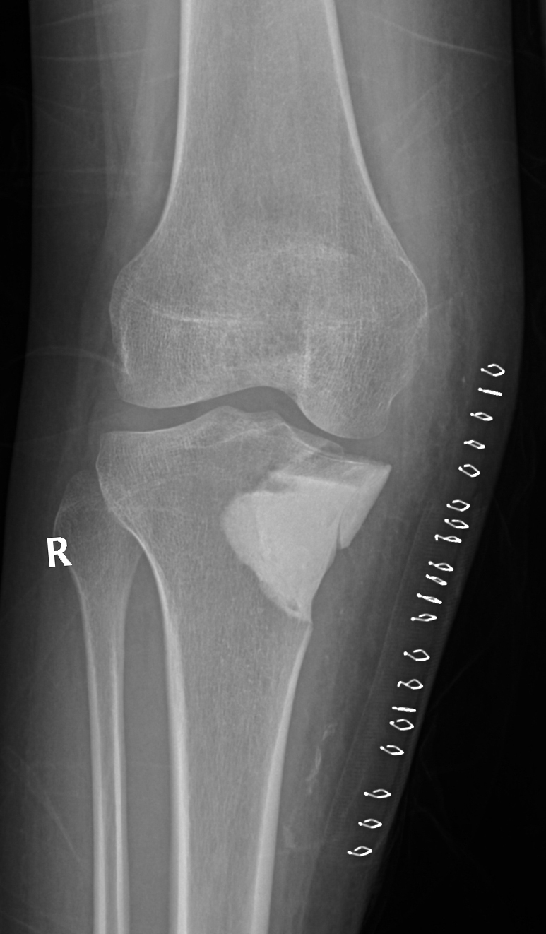 AP knee