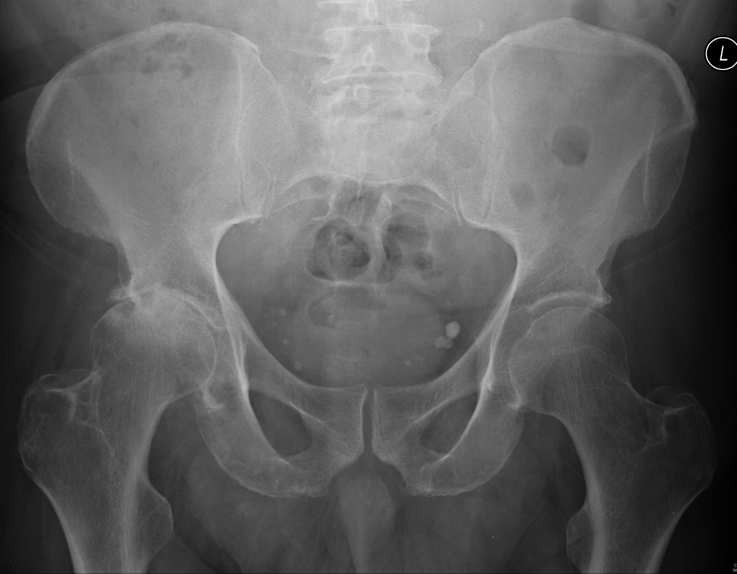 | AP pelvis