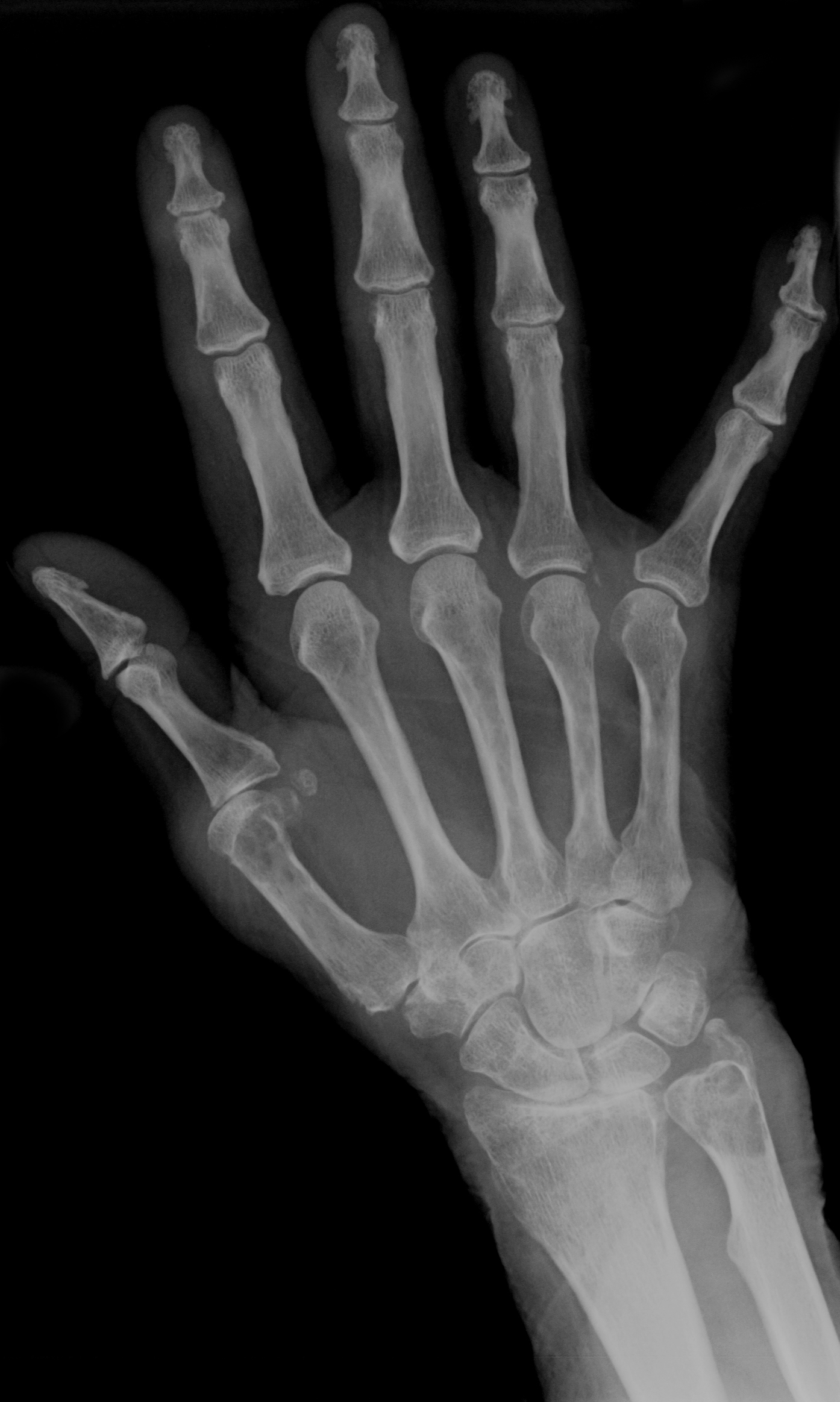 | PA hand