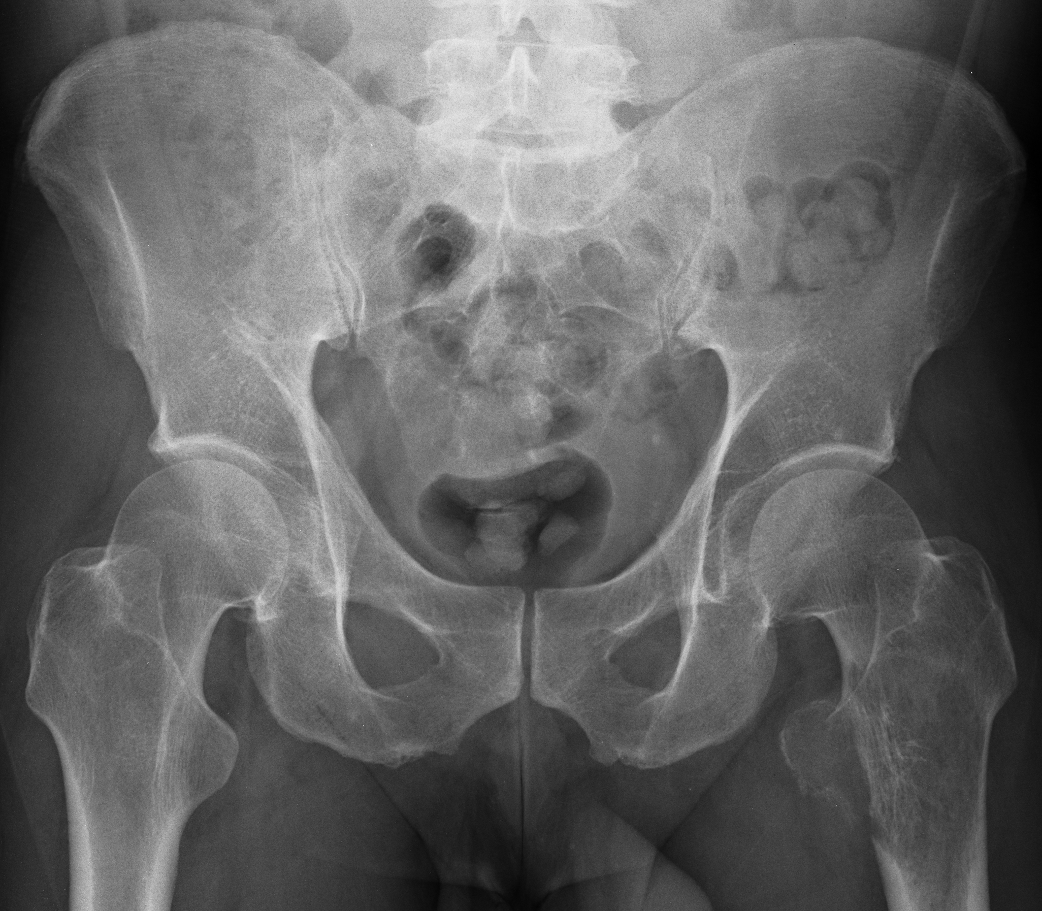 | AP pelvis