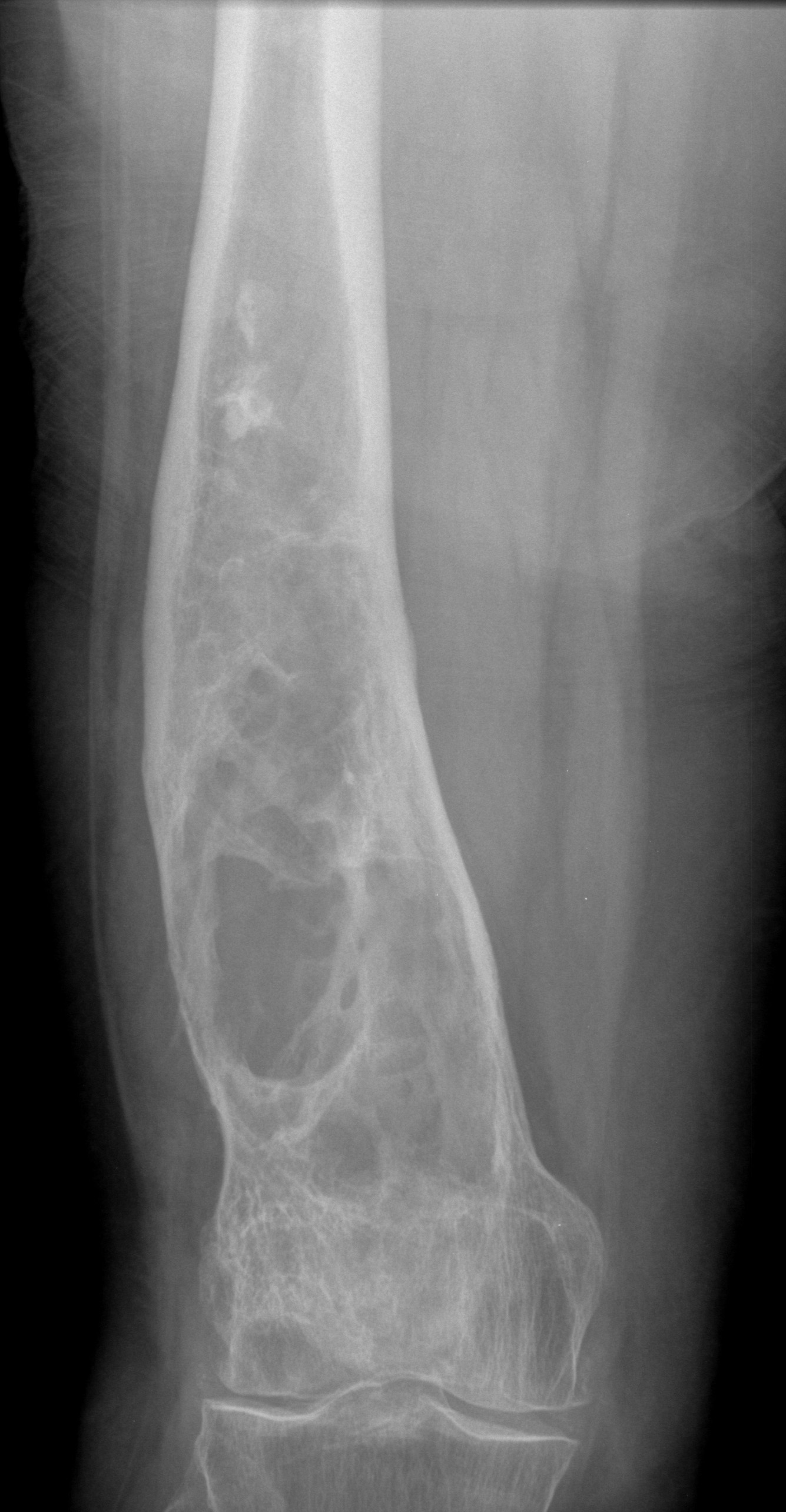 | AP knee