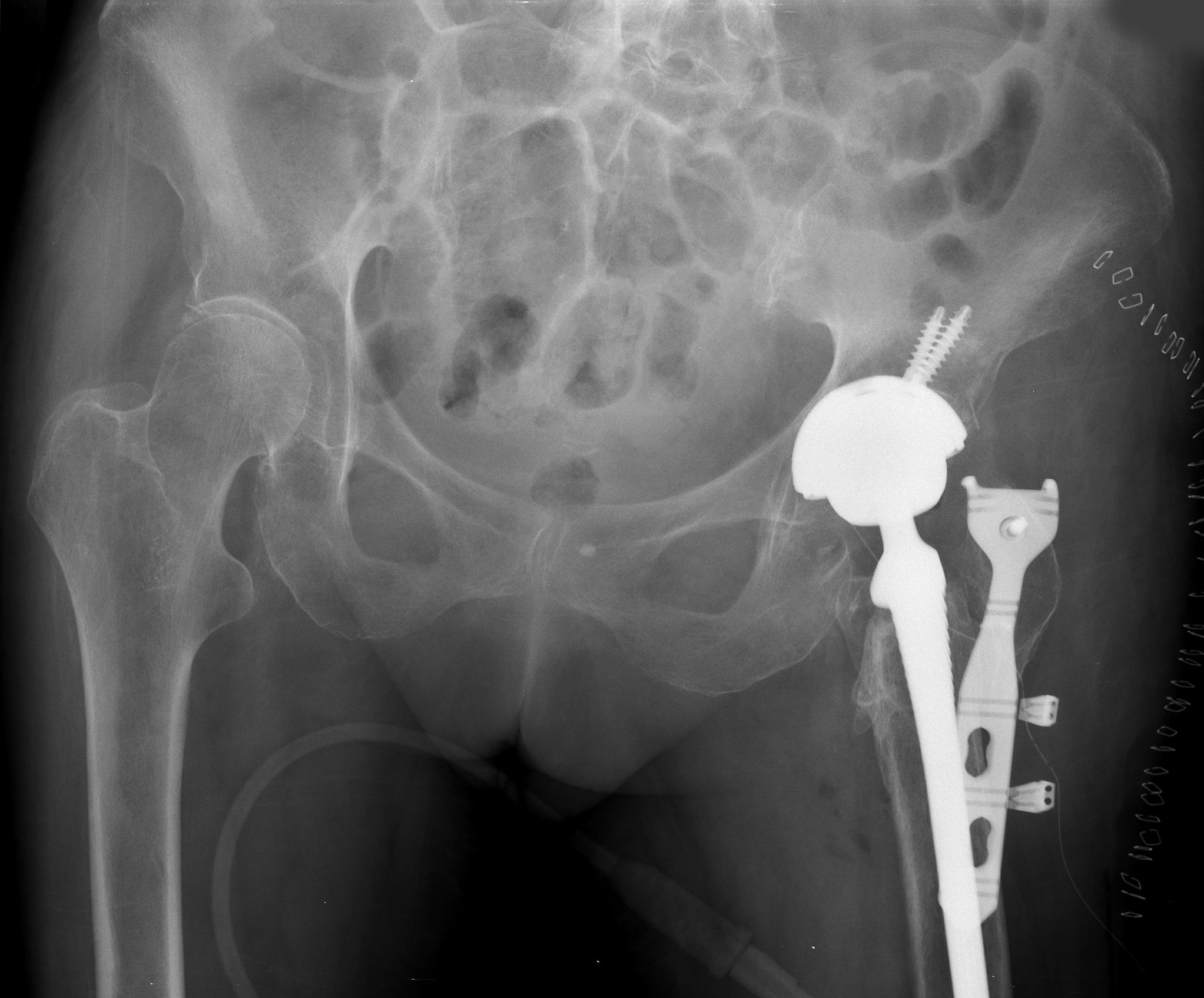 AP pelvis