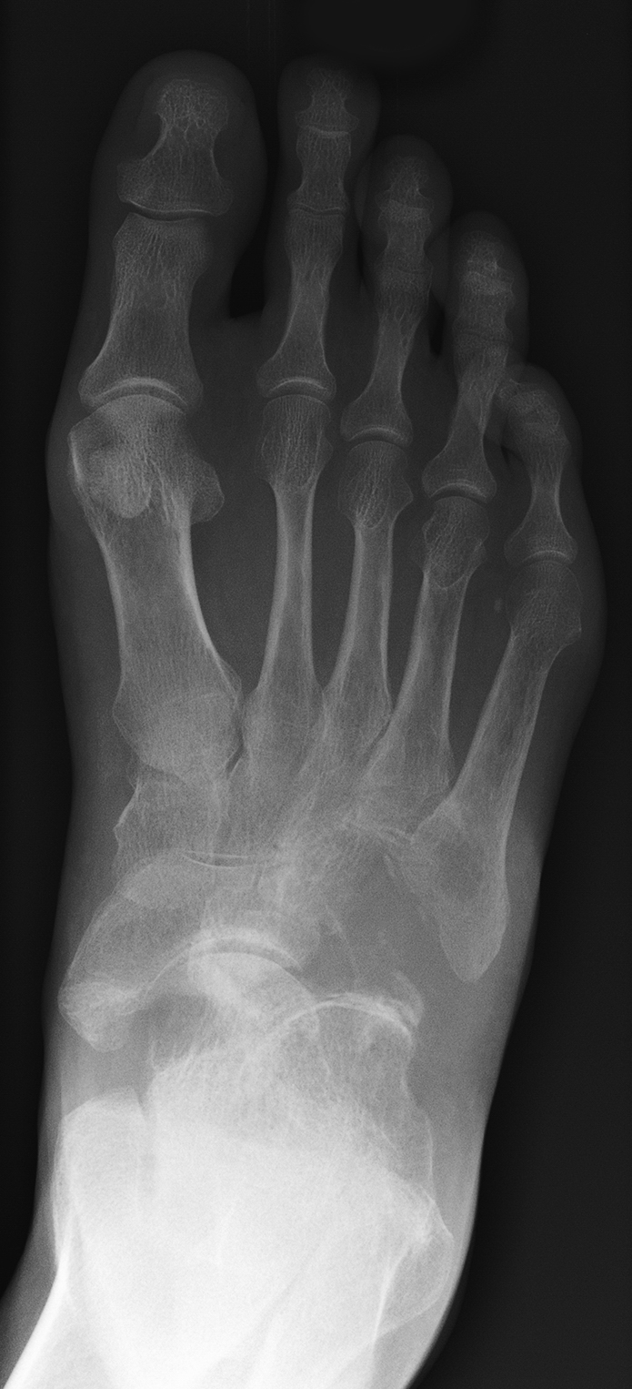 DP foot