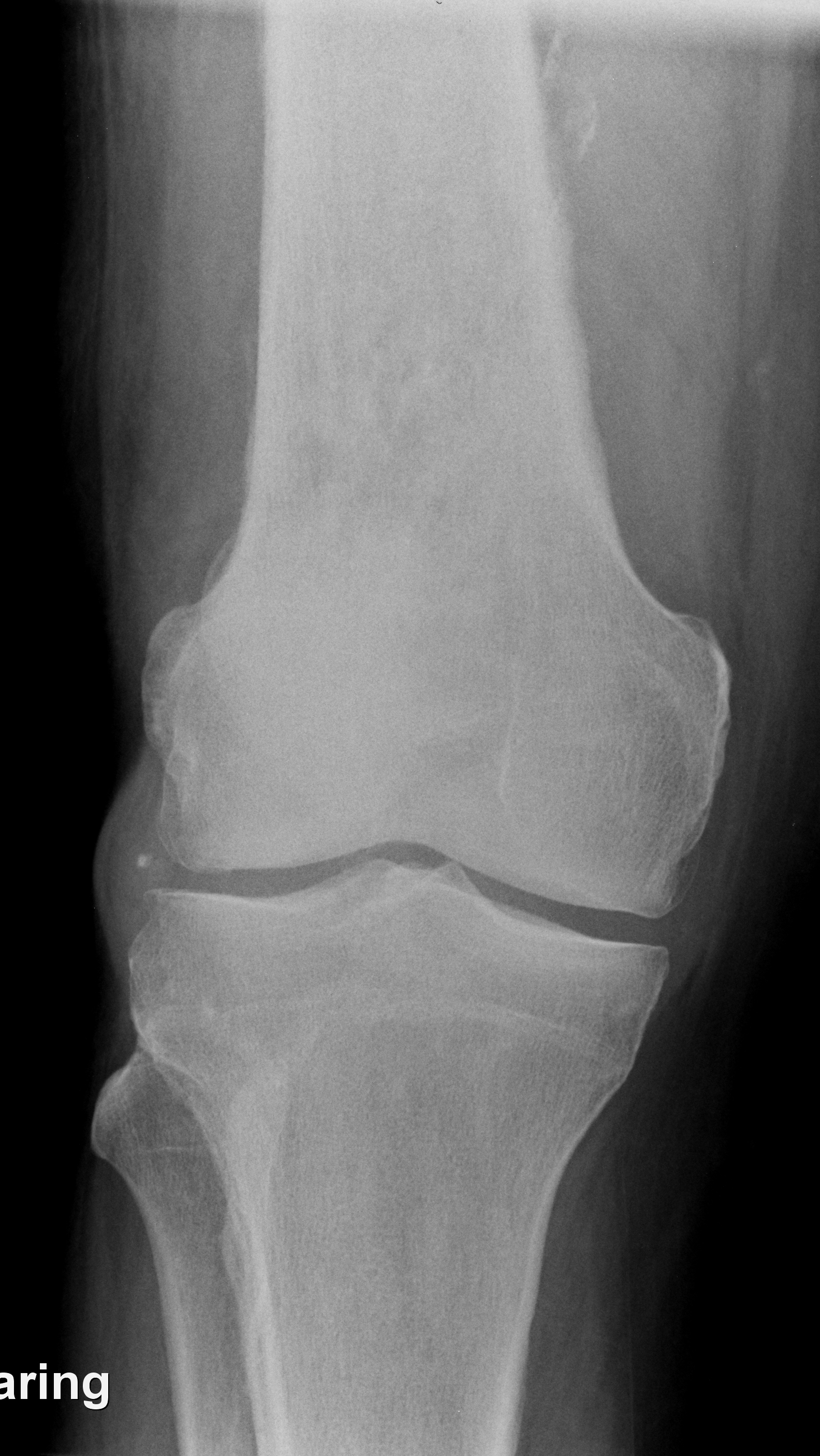 | AP knee