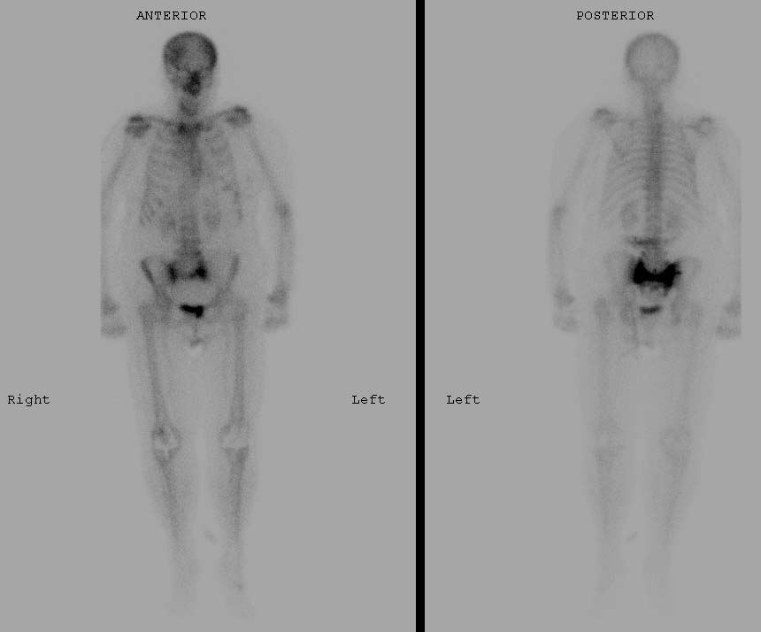 | Whole-body bone scintigraphy