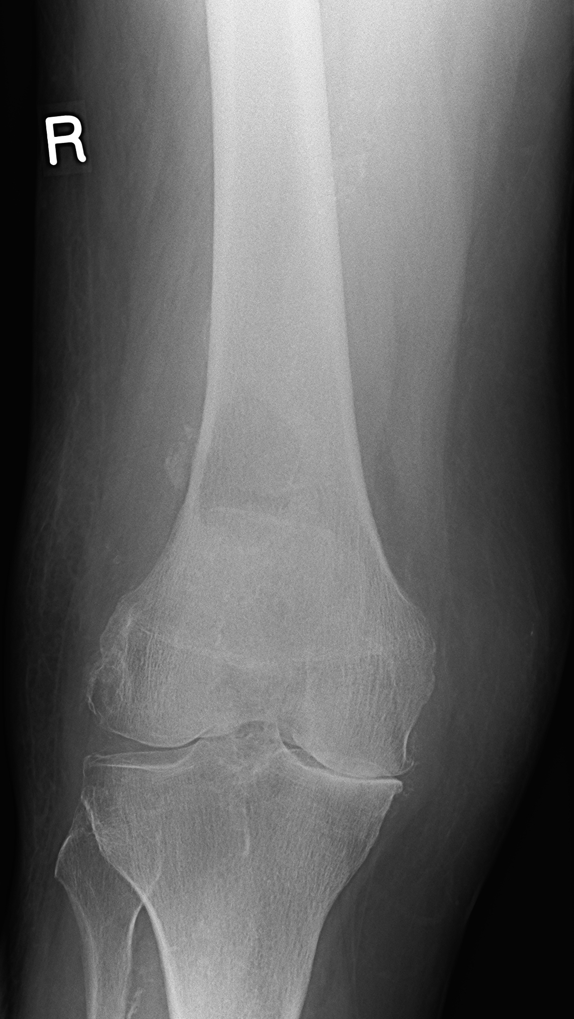 AP knee