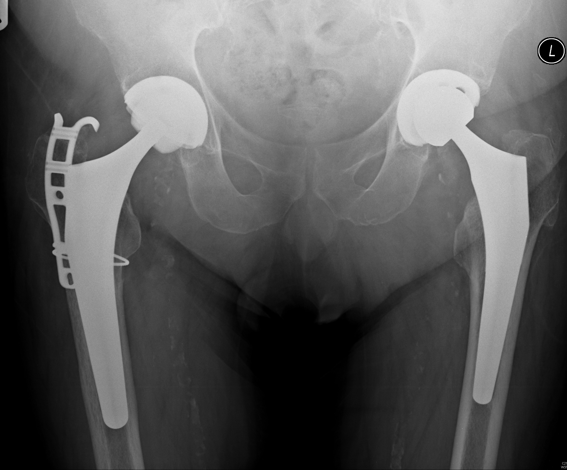 | AP pelvis