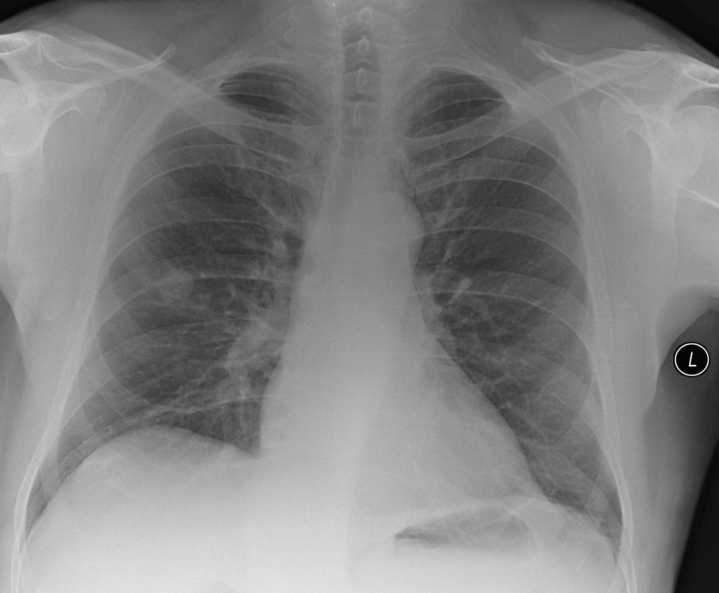 PA chest